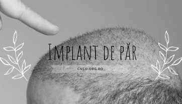 Implant De Par